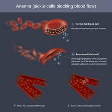 Spotlight On Sickle Cell Disease September Is Sickle Cell Disease Awareness Month The Pain Community