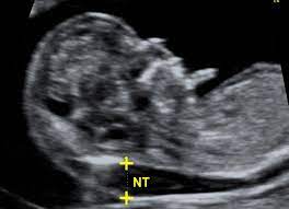 Check that the basic anatomy of the head, body and limbs appears normal for this stage of pregnancy. Nuchal Translucency Scan Fmf Certification Welcome To The Fetal Medicine Foundation