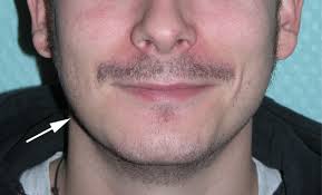 Mandibular traumatic peripheral osteoma: a case report