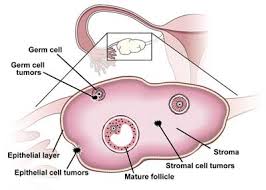 Common tumour markers currently in use: Ovarian Cancer Aacc Org