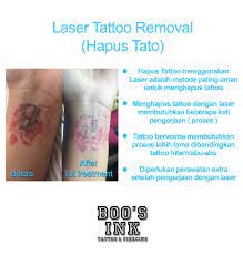 Tattoo Removal Jakarta Tattoo Design