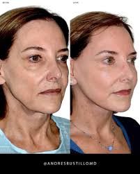 Female underwent a Deep Plane Facelift. Her result is elegant, natural, and  conservative. #DrBustillo #NaturalResults #ConservativeResults