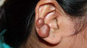 Keloid On Ear Piercings Other Causes Treatment Removal Preve