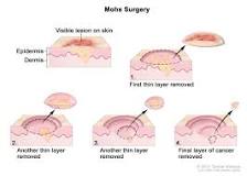 Image result for how soon amigo carsona of soft tissue come back after cancer treatment