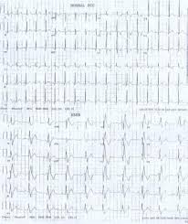 Image result for Bundle Branch Block