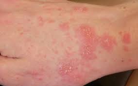 Maybe you would like to learn more about one of these? 10 Obat Rumahan Dari Bahan Alami Untuk Mengobati Gatal Dan Iritasi Pada Kulit