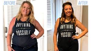 Affordable Bariatric Surgery Mexico Weight Loss Surgery Cost