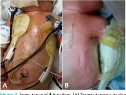 Image result for Transcutaneous Pacing