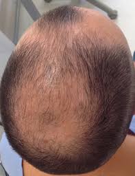 Hair at the top of the head also thins, often progressing to baldness. Androgenetic Alopecia Article