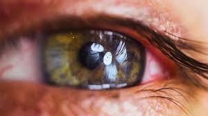 Contact your doctor if you notice any signs of jaundice. Can Having Crohn S Disease Affect Your Eyes Everyday Health
