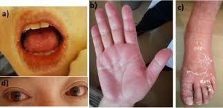 Image result for kawasaki disease symptoms image