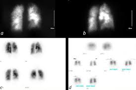 Image result for Ventilation Perfusion Scan