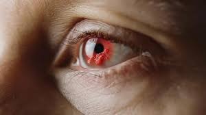 Image result for Eye Pain without Redness