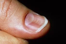 Nail abnormalities can result from injuries. Nail Problems Nhs