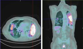 Can return to non smoker risk if quit before age 30 or if only smoked 5 years; Pet Ct In Nononcological Lung Diseases Current Applications And Future Perspectives European Respiratory Society