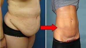 The best way to lose a belly apron is through prevention. How To Get Rid Of Hanging Belly After C Section Safe Reliable Tips