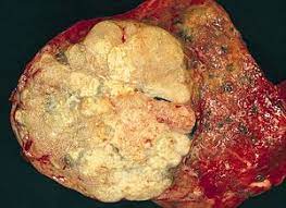 Iesalnieks i1, trupka a, raab m, glockzin g, woenckhaus m, schlitt hj, agha a. Adenocarcinoma Of The Lung Wikipedia