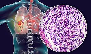 Many people with lung cancer are all too aware that lung cancer can spread. Imfinzi Approved In Eu To Treat Extensive Stage Small Cell Lung Cancer