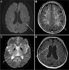 Scopri ricette, idee per la casa, consigli di stile e altre idee da provare. Cerebral Magnetic Resonance Imaging Of Coincidental Infarction And Small Vessel Disease In Retinal Artery Occlusion Scientific Reports
