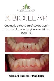 This Is An Example Of How You Can Use The Bioclear Matrix To Cosmetically Correct The Black Triangles Created By Re Dental Design Dental Dental Implant Surgery