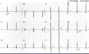 Image result for Q Wave