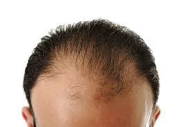 If you notice thinning at the crown, male pattern baldness is the most likely culprit. Main Causes Hair Loss In Men And How To Treat Trichostem