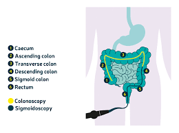 If your loved one is dying from colon cancer, they most likely have diffuse metastases —or the spread of cancer outside of their colon to other organs and lymph nodes, as well as tumors in and around their colon. Hospital Tests Diagnosis About Bowel Cancer Bowel Cancer Uk