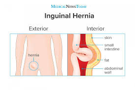 Check with your doctor sounds like it could be an inguinal hernia, and it maybe the bowel is pushing to * the area while you are walking or gravity is pulling area down. Inguinal Hernia Surgery Symptoms And Causes