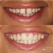 ♡in this video i talk about my experience with braces and how i my gap reopened after braces. Pin On Before And After