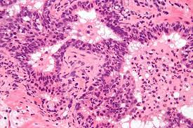 Prostatitis Prostataentzundung