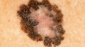 What does skin cancer look like? Is It Skin Cancer 38 Photos That Could Save Your Life Pictures Cbs News