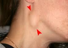 Bumps that are cancerous are typically large, hard, painless to the touch and appear spontaneously. Oral Cancer Wikipedia