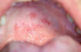 Image result for Candidiasis