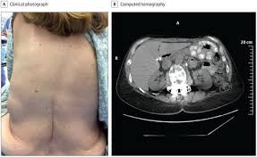November blev udnævnt til professor i rygkirurgi ved sygehus lillebælt og institut for regional sundhedsforskning på syddansk universitet. Chronic Back Pain And A Bulge Jama Surgery X Mol