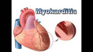Myokarditis oder pankarditis läuft ein akuter oder chronischer. Myokarditis Krankheiten Des Herzens Pflege Kanal Youtube