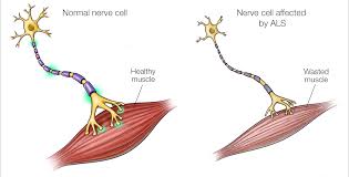 What is amyotrophic lateral sclerosis (als)? Als The Neurology Group