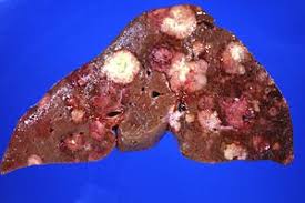 We did not find results for: Liver Disease Wikipedia