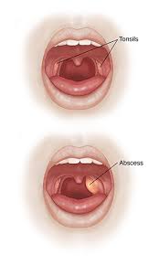 Peritonsillar Abscess Saint Luke S Health System Basically, i ate salt and vinegar pringles earlier and now my top lip is really swollen. peritonsillar abscess saint luke s health system