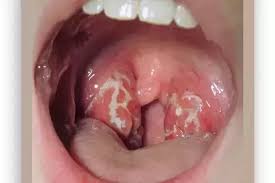 Eat a spoon of honey daily, as honey heals wounds faster. I Have Pus Forming In My Tonsils And A Sore Tongue Do I Have Cancer Or Something Should I Go To A Doctor Quora