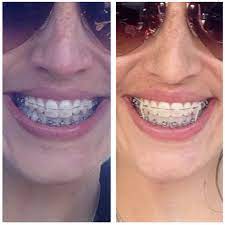 Dec 06, 2014 · and when you want your teeth straightened, the best option is always to see an orthodontist and get braces. Six Months In Braces Kaplan Orthodontics