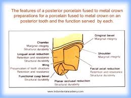 Image Result For Molar Pfm Crown Prep Porcelain Crowns