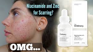 Acne like pimples, blackheads and whiteheads start with a clogged pore. I Tested The Ordinary Niacinamide And Zinc Serum For My Acne Scars One Month Shocked By This Youtube