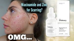 review the ordinary niacinamide 10% + zinc 1% (before and after). I Tested The Ordinary Niacinamide And Zinc Serum For My Acne Scars One Month Shocked By This Youtube