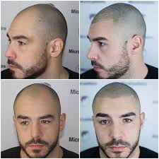 Loss of hair on the top of your head can be traumatic, but a lesser known problem that afflicts a lot of men is beard growth trouble. Galerie Microcapillaire Balding Mens Hairstyles Hair Loss Solutions Bald Hair
