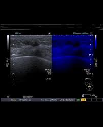 The best way to fight breast cancer is early detection. Double Recurrence Of Breast Tumor At Mastectomy Site Radiology Case Radiopaedia Org