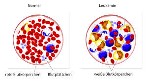 Leukamie Blutkrebs Symptome Anzeichen Behandlung Verbreitung Risikofaktoren