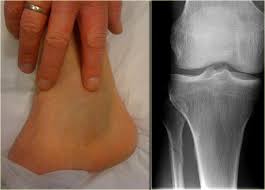 Posted by rathachai kaewlai, m.d. The Radiology Assistant Special Cases Of Ankle Fractures