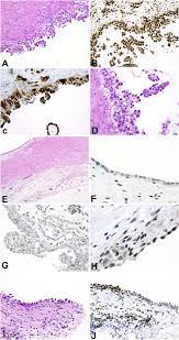 Your doctor may order imaging. Malignant Mesothelioma In Situ Diagnostic And Clinical Considerations Pathology