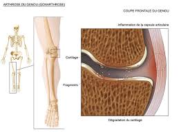 Pour réduire l'ampleur de cette inflammation, vous devez faire l'effort de consommer des aliments antiinflammatoires. Definition Symptomes Et Diagnostic De L Arthrose Du Genou Dr Paillard