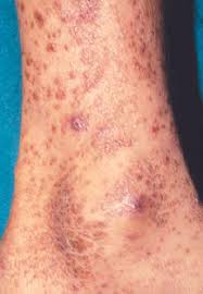The tuberculosis skin test (also known as the tuberculin or ppd test) determines whether a person has developed an immune response to the tuberculosis skin test (ppd skin test). Jaypeedigital Ebook Reader